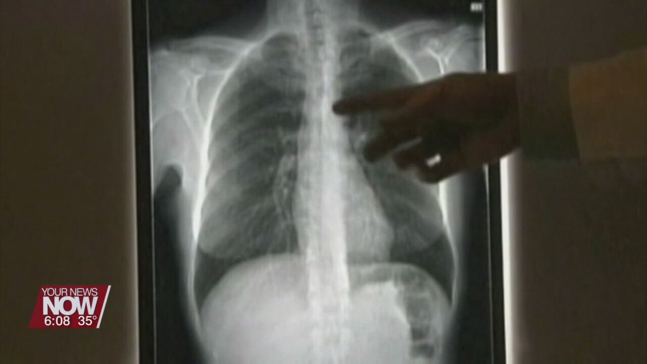 Lung screening can help detect lung cancer earlier